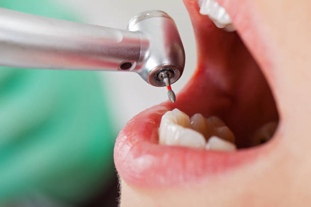 Best Emergency Treatment for Dental Infections or Abscesses in Vancouver, WA